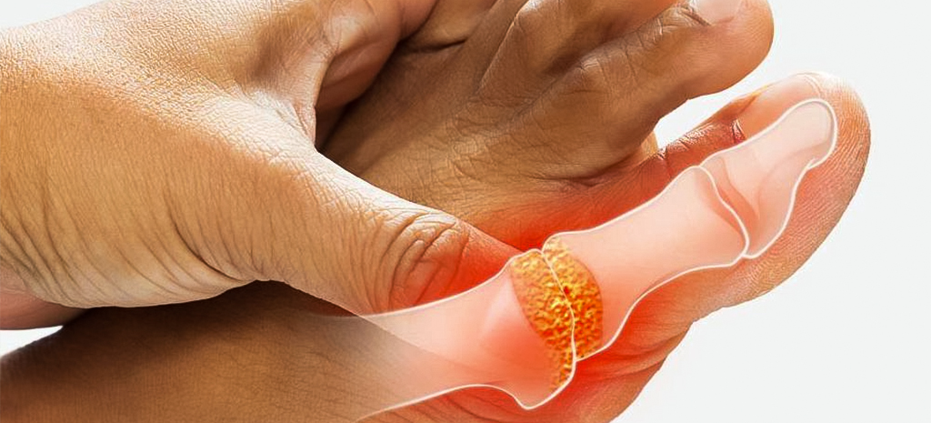 ketogenic diet for gout relief